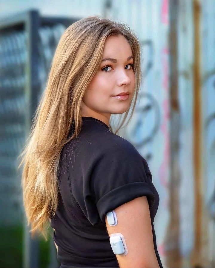 Chloë wearing Medtrum TouchCare Nano CGM and pump on her arm for type 1 diabetes management